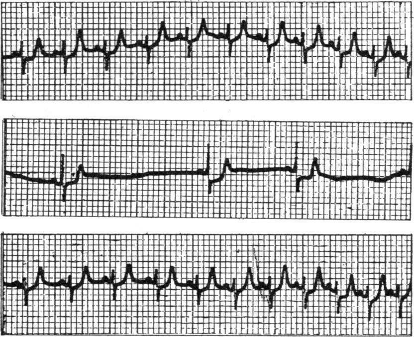 RESULTS Conscious Animals The intravenous injection of succinylcholine causes an immediate and profound bradycardia at the onset of paralysis. The heart rate falls from 250 to 50/min.
