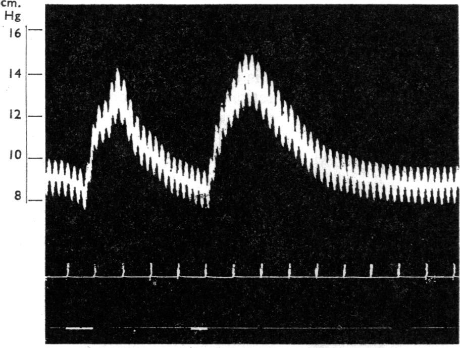 ACTIONS OF SUCCINYLCHOLJNE FIG. 4.-Adrenalectomized dog under pentobarbitone anaesthesia. Succin: choline 50 mg. (at 1st signal) and 60 mg. (at 2nd signal) iv. causes rise in blood pressure.