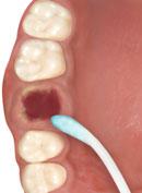 Cleaning the operation site Clean the rest of your teeth and gums with a soft toothbrush and toothpaste.