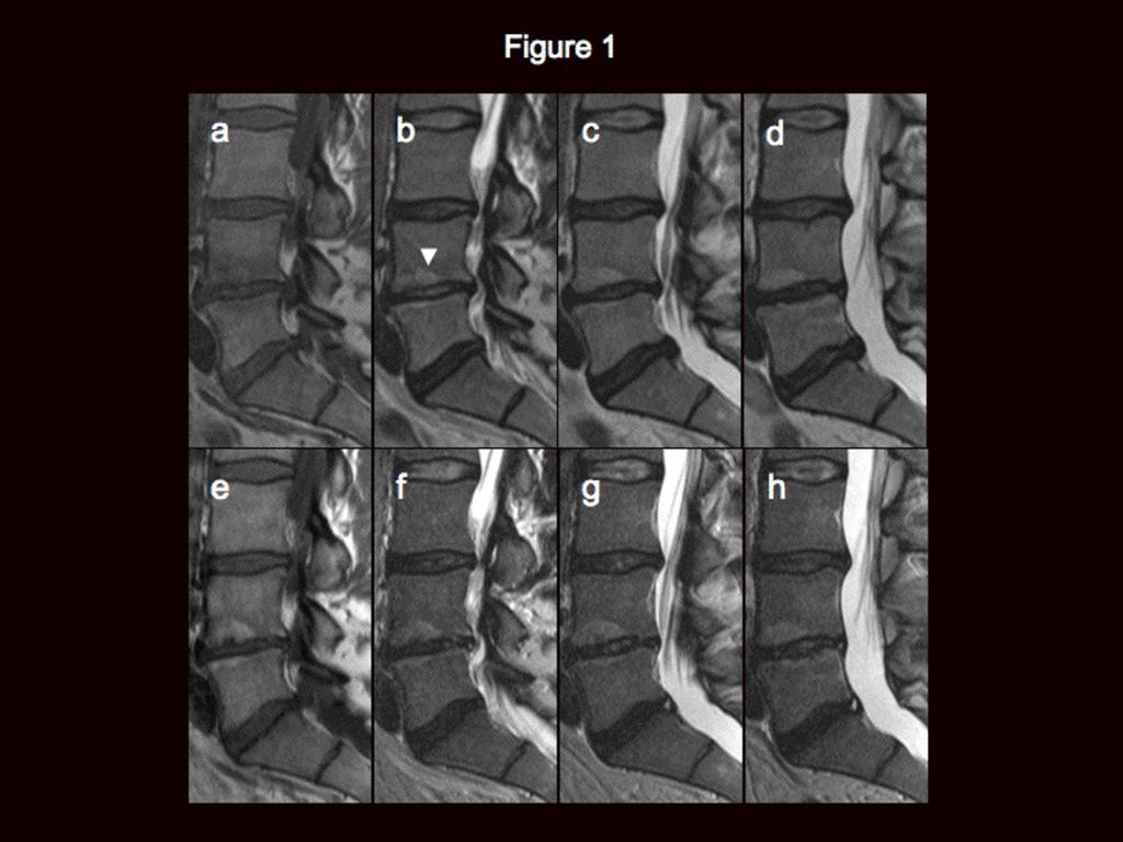 Fig. 1: Fig. 1 Pre-treatment (a#d) and 2-year follow-up (e#h) MRI of one patient.