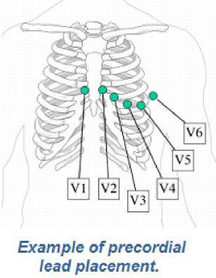 Leads I, II, and III represent a picture of the heart s electrical conduction from viewpoint of the limb to the heart.