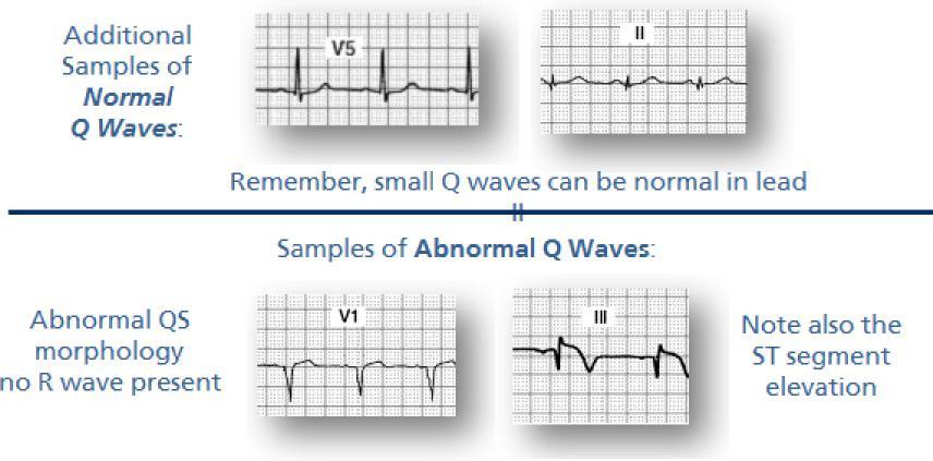 Samples of Q Waves More Information: Abnormal Q s are wider and deeper than the normal Q wave.