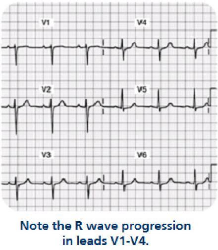Normal R Waves There should be an R wave in each of the 12 leads except in lead avr.