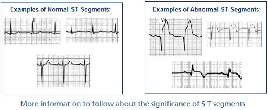 Introduction to S-T Segments Observe the ST segment and junction point (J-point) morphology. The J-point is located at the end of the QRS where the T wave begins.
