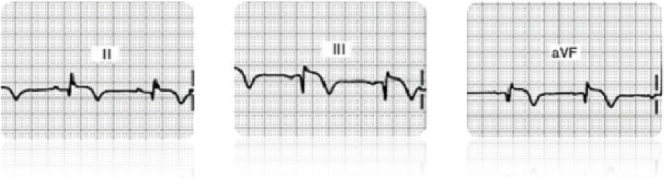 ECG Findings with Inferior Wall MIs Do you see