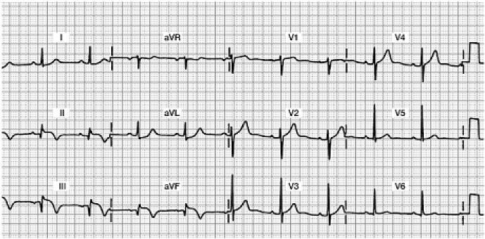Acute Inferior Wall MI 12-Lead ECG Focus on Leads II, III, and avf Do you see any abnormalities?