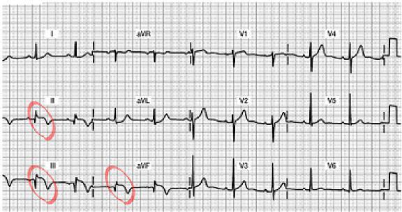 Acute Inferior Wall MI 12 Lead ECG Do you see the 12 lead ECG abnormalities? Acute ST segment elevation in Leads II, III and avf... this is a marker of acute injury Inverted T wave.