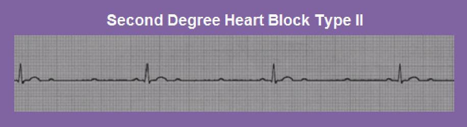 AV block: Parasympathetic hyperactivity is common with IWMI so watch for first, second (usually Type I), third degree conduction delays or blocks that may occur within hours or up through the first