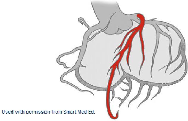 Acute anterior wall MIs (AWMI) are a serious form of STEMI since there is acute damage to the left ventricle.