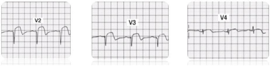 ECG Findings with Acute Anterior Wall MI Infarcted tissue on the anterior wall of the ventricular myocardium will no longer depolarize toward the anterior chest wall (where the positive electrodes V1