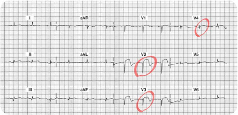 Acute Anterior Wall MI 12 Lead ECG Do you see the 12 lead ECG abnormalities? Acute ST segment elevation in Leads V2, V3, and V4... this is a marker of acute injury.