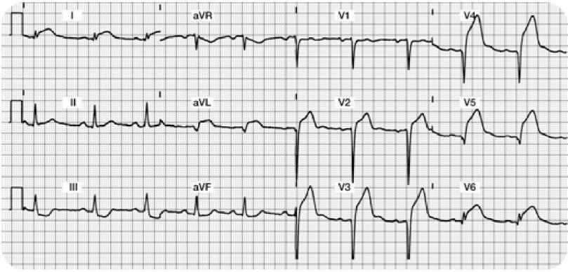 Acute Anterior Lateral Wall MI 12 Lead ECG Focus on Lateral Leads: I, avl, V5 and V6 along with Anterior