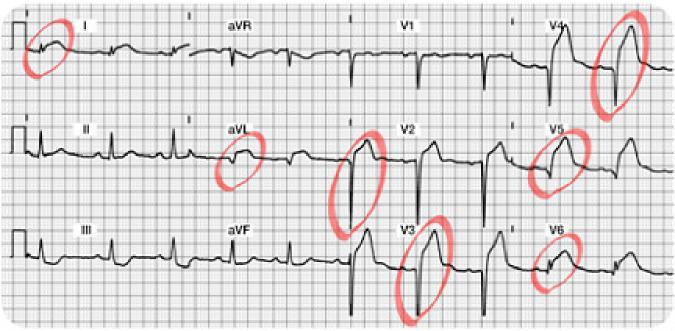 Acute Anterior Lateral Wall MI 12 Lead ECG Answers Do you see the 12 Lead ECG abnormalities? Acute ST segment elevation in Leads I, avl, V5, and V6 (the lateral leads!