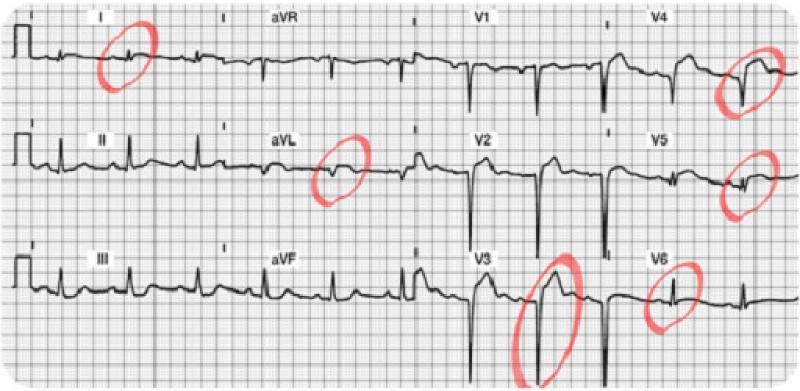 Patient Scenario 1b Note the dramatic reduction of ST segment elevation in Leads I, avl, V3, V4, V5 and V6.