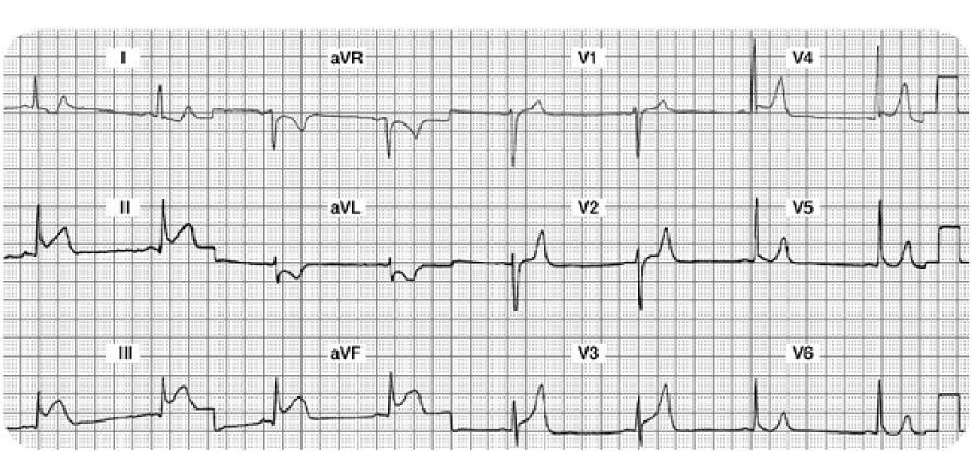 Case Study One Mr. A is admitted to your unit with the diagnosis of chest pain, rule out MI. He is currently pain free with stable vital signs.