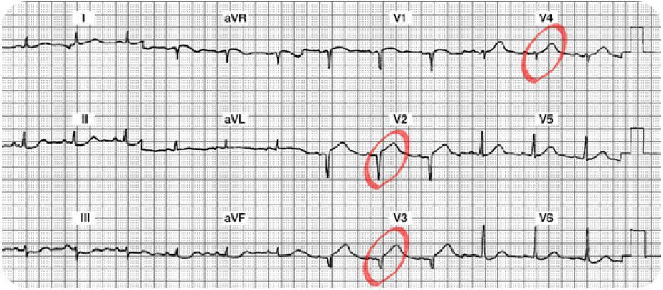 Case Study Three: 12 Lead Worksheet Answers Summary of the Lateral Leads (I, avl, V5 and V6): Leads I, avl, V5 and V6 are all normal. There are no abnormal Q waves, no ST-T abnormalities.