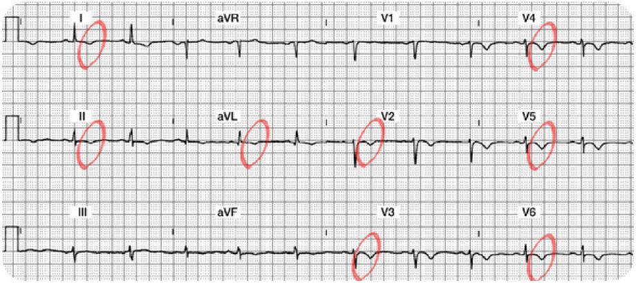 Case Study 4 Lead Worksheet Answers Summary of the Lateral Leads (I, avl, V5 and V6): In Lead I, there is a normal Q and R wave. The ST segment is slightly depressed and the T wave is inverted.