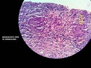 Slide showing granuloma. Discussion Primary tuberculous tenosynovitis and bursitis are rare conditions.