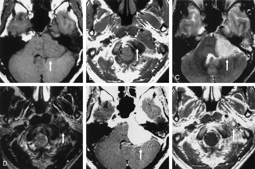 MR signal intensity of intracranial component (arrow in A, C, and E) for JFM is higher than that of the extracranial component (arrow in B, D, and F) on T1-, T2-, and postcontrast T1-weighted images.