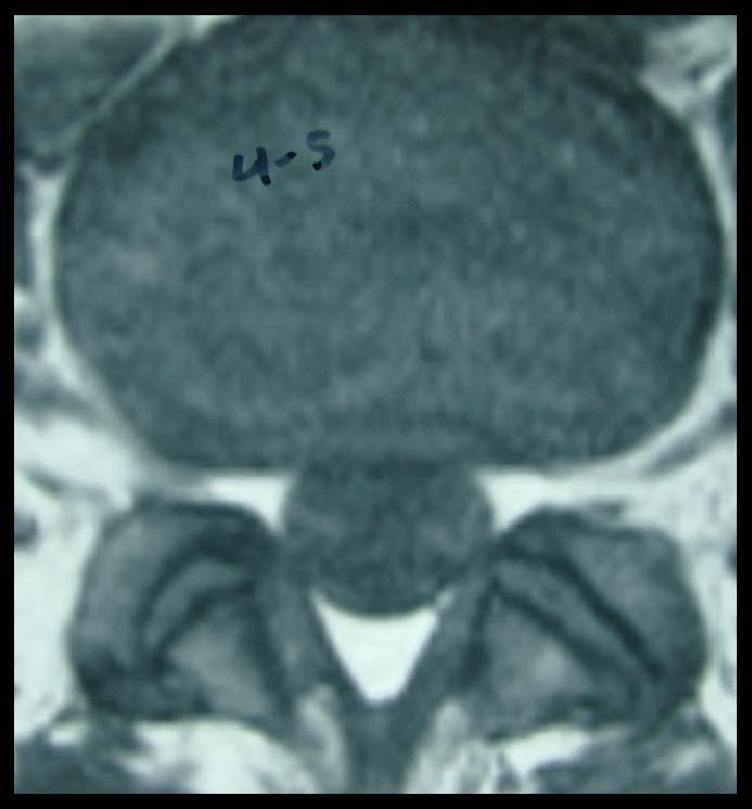 Sagittal view of the L5-S1 disc herniation.