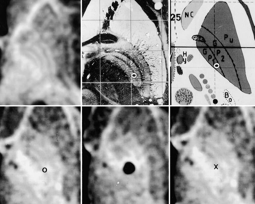 N. Vayssiere, et al. FIG. 1. Upper Left: Axial transverse 3D spoiled-gradient MR image of the left basal ganglia obtained under stereotactic conditions.
