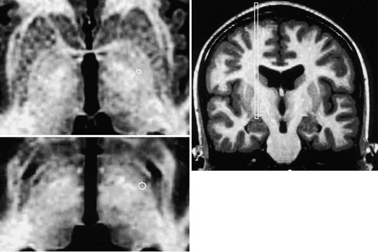 Targeting of the globus pallidus FIG. 2. Upper Left: Reconstructed MR image demonstrating target selection on the brain slice containing the AC.