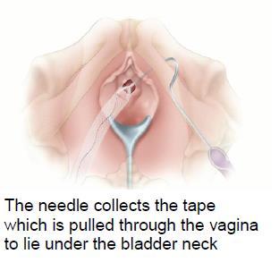 Figure 3 Insertion of transobturator tape (TVT-O) (Images courtesy of Ethicon) An alternative operation to the TOT: Tension free vaginal tape (TVT) This operation involves inserting a synthetic tape