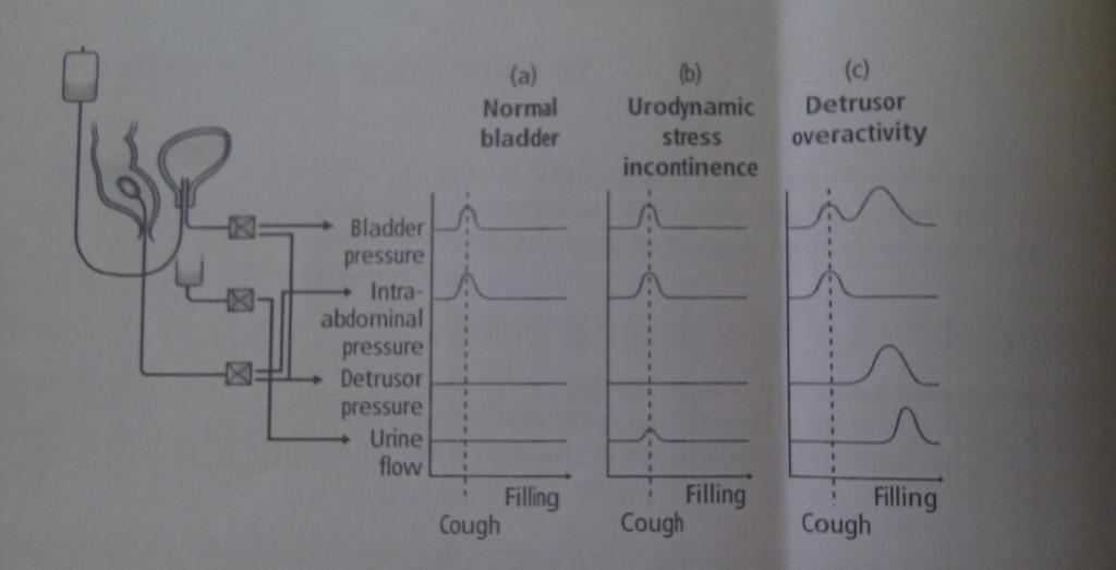Urodynamic investigations (a) Normal bladder no detrusor contraction, no urine flow with cough.