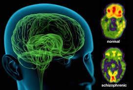 Schizophrenia: basic definition Schizophrenia is a chronic and severe mental disorder that affects how a person thinks, feels, and behaves.