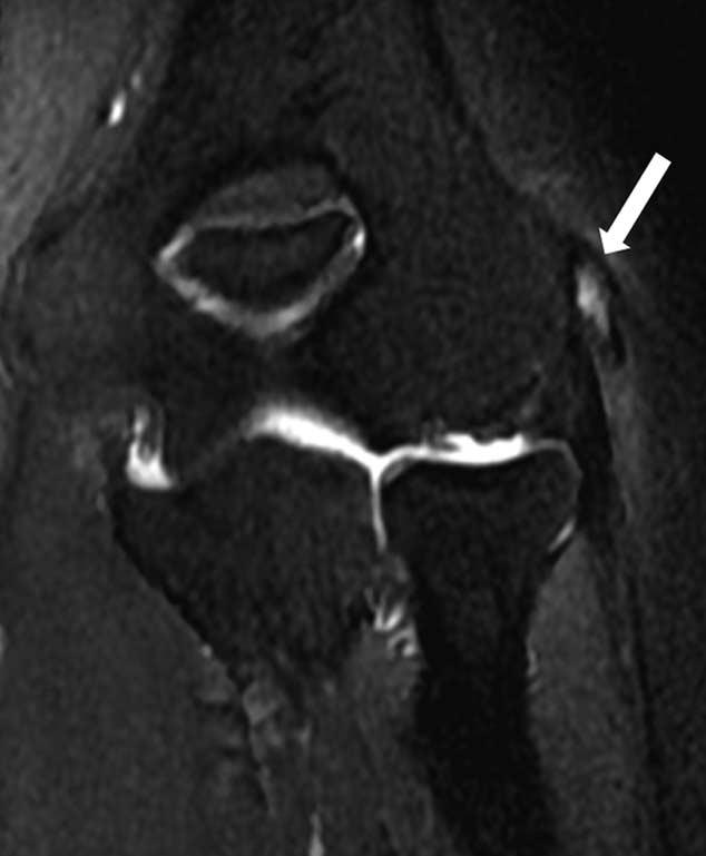 Medicine Volume 95, Number 5, February 2016 Magnetic Resonance Imaging of Chronic Lateral Epicondylitis FIGURE 2. 54-year-old man with left elbow pain 1.
