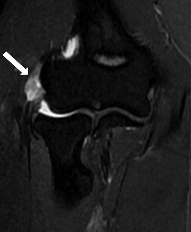 PRTEE ¼ Patient-Rated Tennis Elbow FIGURE 3. 40-year-old woman with right elbow pain 2 years (Tendinopathy score ¼ 3; PRTEE score ¼ 89).