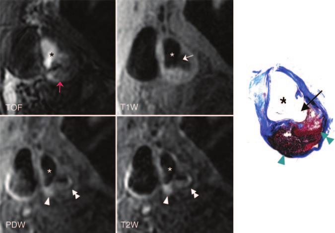 Takaya et al Carotid MRI and Future Cerebrovascular Events 821 Figure 2.