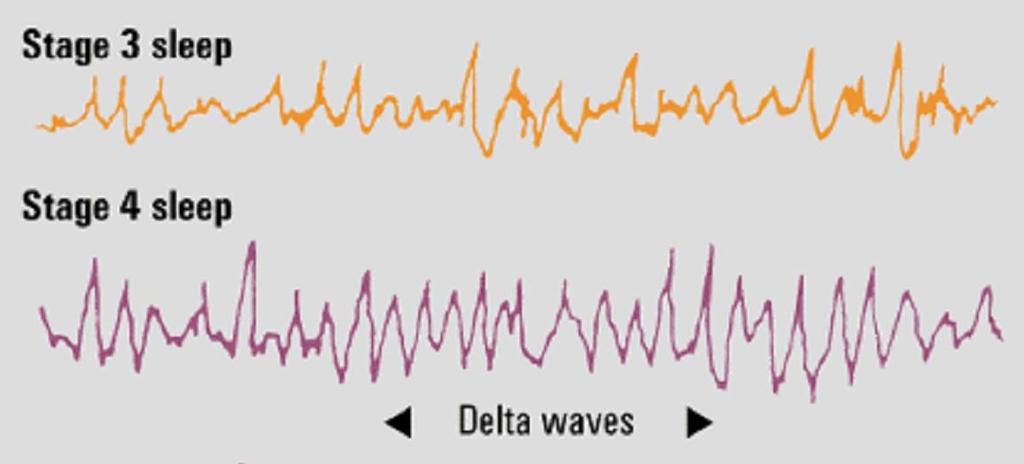Stage three: the third stage of sleep that is a transition stage into stage four, first emission of delta waves.