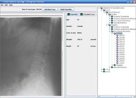 X-ray image and use the system to automatically generate the labeling points. The user can then click on the analysis button to analyze the spinal conditions and diagnose lumbar spinal stenosis.