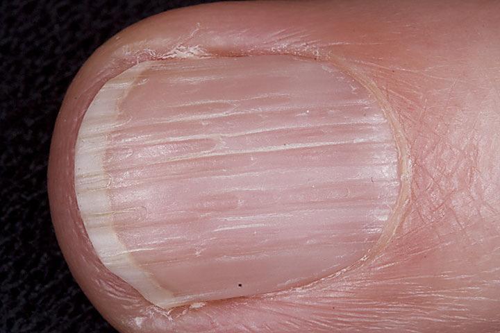 NAIL Strong, rigid, thick, corrugated (Sycotic) + Groove or indentations (pot holes) on nails