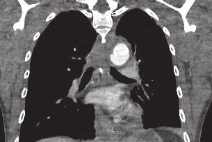 Sagittal CT Angiography