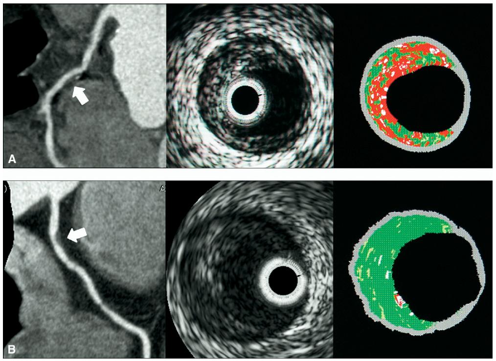 Correlation of CT and VH-IVUS N=59 pts, 80 lesions Am
