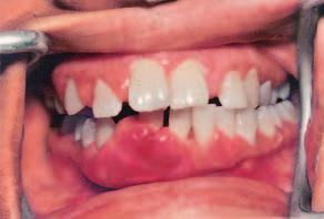 296 Mahajan et al Gingival enlargement associated with gap Fig 1a and 1b Pretreatment situation, showing marked gingival enlargement and spacing between teeth.