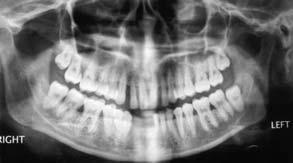 Earlier described as generalised juvenile periodontitis, gap may be diagnosed based on the following findings 2 : usually affecting persons under 30 years of age (however, may be older); generalised