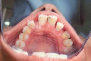 Mahajan et al Gingival enlargement associated with gap 297 the teeth except lower central incisors, which were Grade-III mobile.
