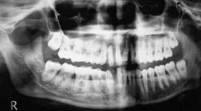 Periodic panoramic radiographic examination revealed progressive generalised bone loss throughout the entire dentition. Microbiological examination revealed elevated levels of Aa.