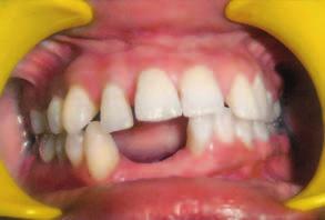 Treatment Periodontal treatment planning, including gingivectomy for the gingival enlargement, was explained to the patient. The patient was given overall instructions in oral hygiene techniques.