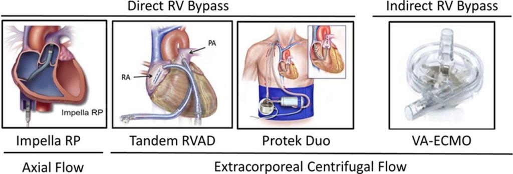 Mechanical circulatory support for RV