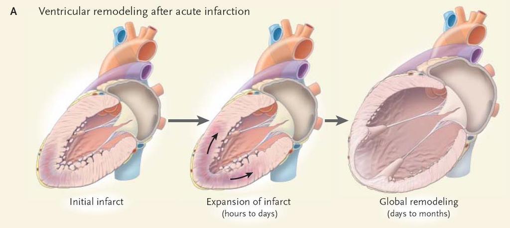 Heart muscle can recover with support High Potential of heart muscle recovery, Gain in Ejection Fraction Low