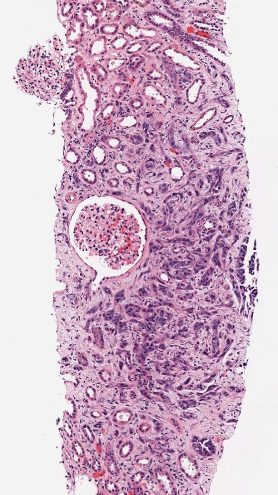 Tumours That Infiltrate Renal Parenchyma Collecting duct/medullary carcinoma