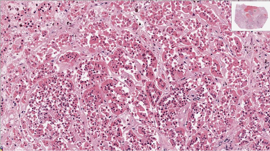 Final Diagnosis papillary renal cell carcinoma, NOS (most likely