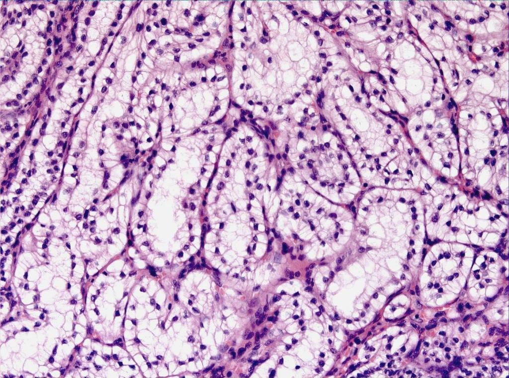 Clear Cell Papillary RCC Tubulopapillary