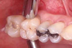 HORTZ-MUGIKORTASUNA Hortz-mugikortasuna neurtzeko bi tresna erabiliko dugu: ispiluaren eta zunda periodontalaren kirtena. Ez erabili zuen atzamarrak mugikortasuna neurtzeko.