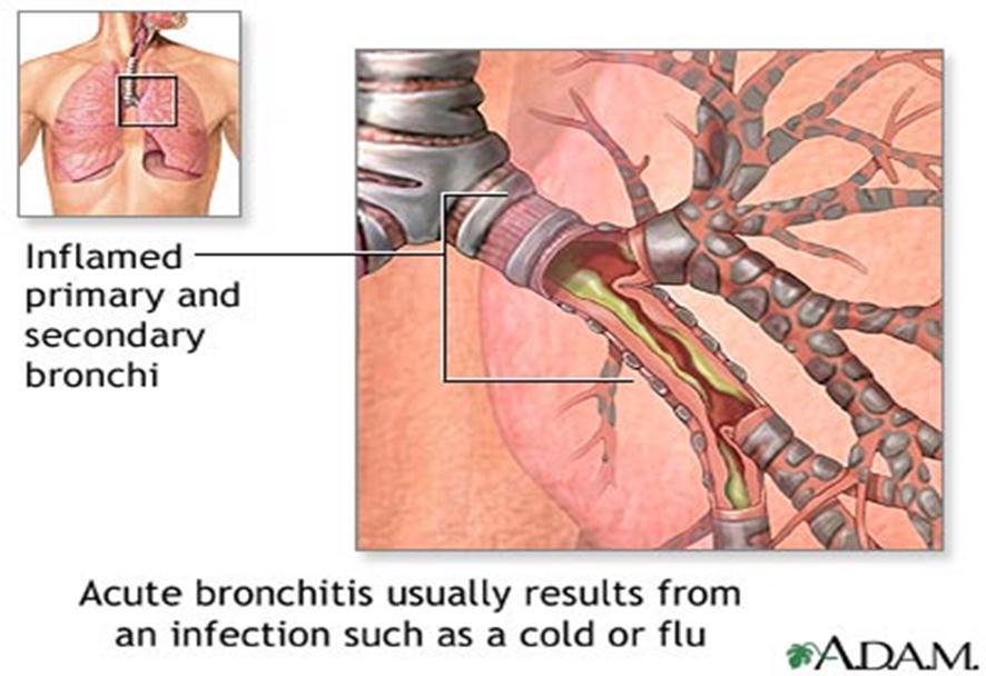 ACUTE BRONCHITIS Learner Study Guide Pathology & Pathophysiology, Chapter 13, pages 92-100 Definition: Short-term inflammation of the bronchi Signs and symptoms: It presents