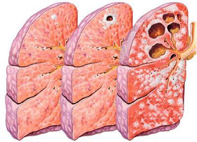 TUBERCULOSIS Signs and symptoms of active stage: A persistent cough that starts